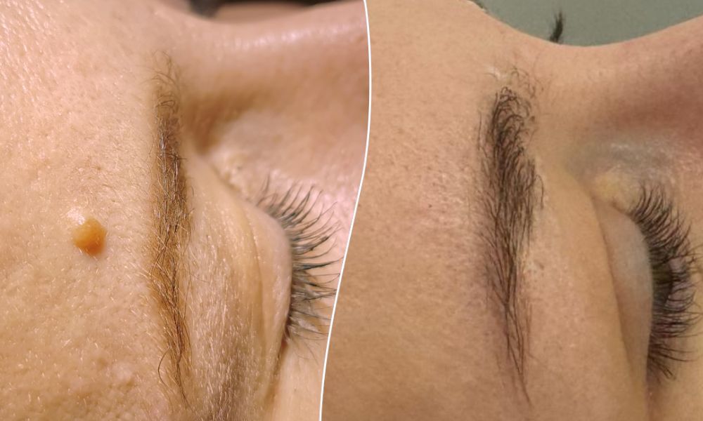 Fotografie ke článku Nebojte se kožních výrůstků – Esthé Laser Clinic