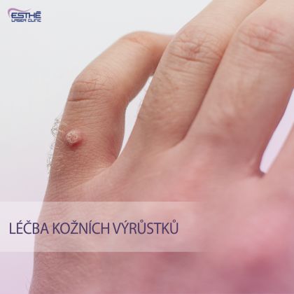 Fotografie ke článku Zbavte se v zimě kožních výrůstků. Je na to nejlepší čas – Esthé Laser Clinic