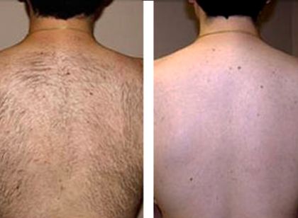 Fotografie ke článku Laserová epilace u mužů – Esthé Laser Clinic