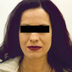 Fotografie ke článku Jak na akné s chemickým peelingem? – Esthé Laser Clinic