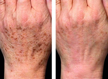 Fotografie ke článku Jak na pigmentové skvrny? – Esthé Laser Clinic