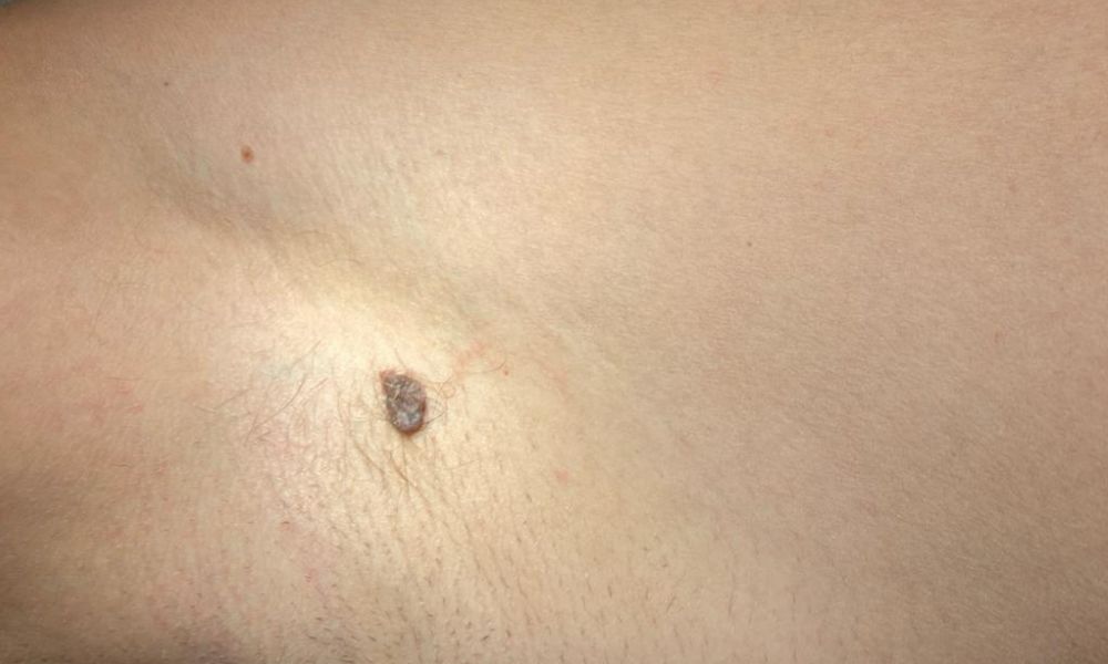 Fotografie ke článku Jak se zbavit névu? – Esthé Laser Clinic