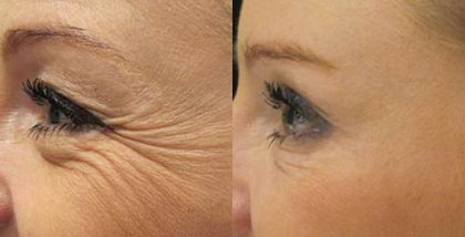 Fotografie ke článku 5 tipů, jak omládnout v Esthé – Esthé Laser Clinic