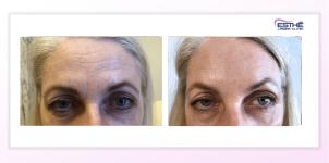 Botulinum toxin – wrinkles on the forehead 
