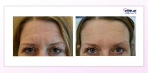 Botulinum toxin – wrinkles on the forehead and between the eyebrows