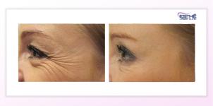 Botulinum toxin – wrinkles in the outer eye corners