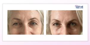 Botulinum toxin – wrinkles around the eyes