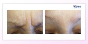 Botulinum toxin – wrinkles between the eyebrows