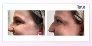Botulinum toxin – wrinkles in the outer eye corners