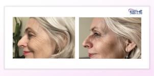 Botulinum toxin – wrinkles in the outer eye corners