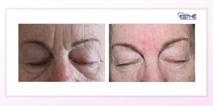 Botulinum toxin – wrinkles on the forehead and between the eyebrows
