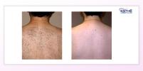 Back epilation