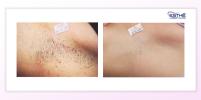 Underarm epilation