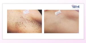 Underarm epilation