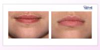 Upper lip epilation