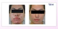 Combination acne treatment