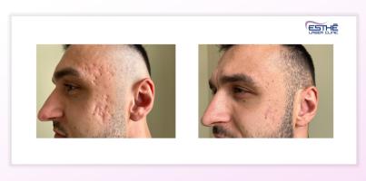 Treatment of acne scars with the Morpheus8