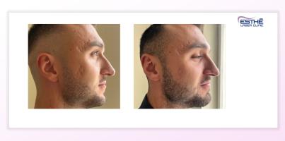 Treatment of acne scars with the Morpheus8