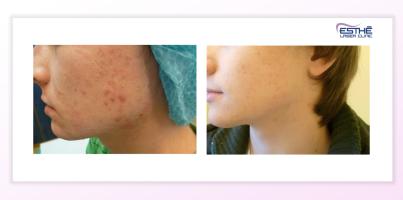 Acne treatment with chemical peeling