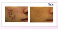 Acne treatment with the Morpheus8