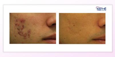 Acne treatment with the Morpheus8