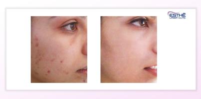 Acne treatment with the Morpheus8