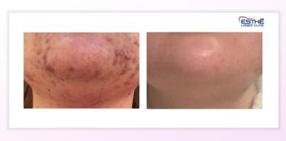 Acne treatment with the Morpheus8