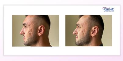 Treatment of acne scars with the Morpheus8