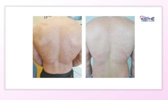 Acne scars treatment