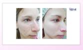 ošetření chemickým peelingem - Esthé Laser Clinic