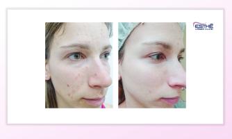 Acne treatment with chemical peeling