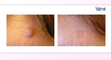 Kožní výrůstky – Esthé Laser Clinic
