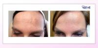 Odstranění melasma