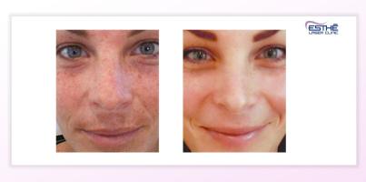 Služba – chemický peeling 2302