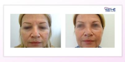 Služba – rejuvenace 2324