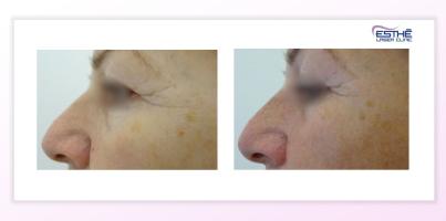 Služba – rejuvenace 2325