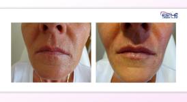 mezoterapie - Esthé Laser Clinic