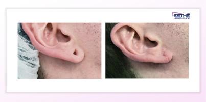 zmenšení ušních dírek po tunelech – Esthé Laser Clinic