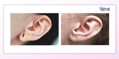 zmenšení ušních dírek po tunelech – Esthé Laser Clinic