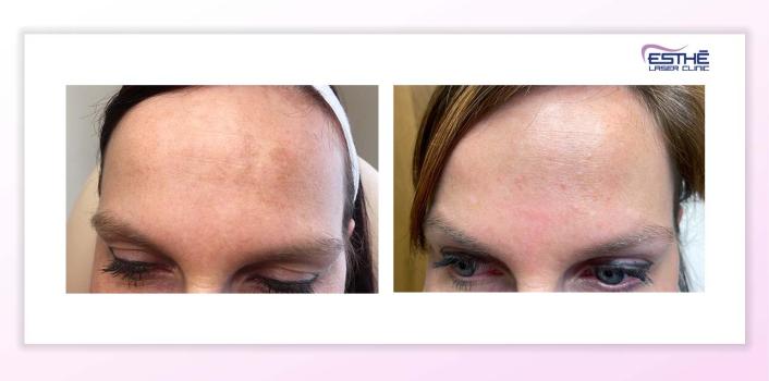 Melasma