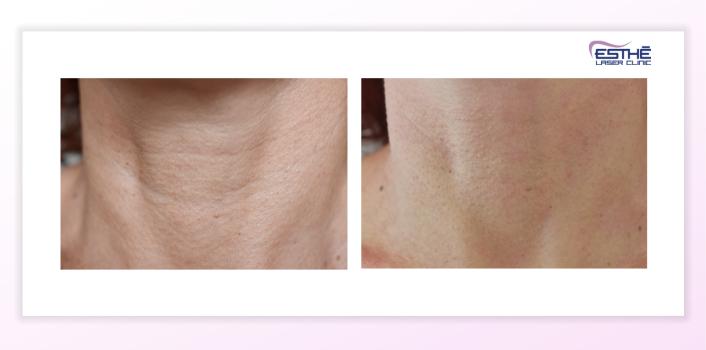 Microneedling