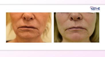 Výplň – koutky úst a nosoretní rýhy