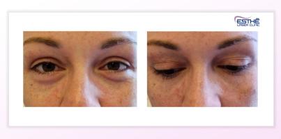 Výplně – kruhy pod očima