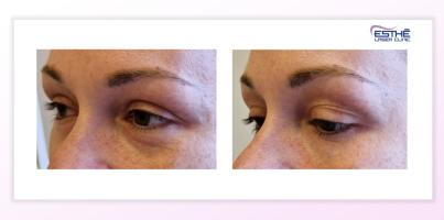 Výplně – kruhy pod očima