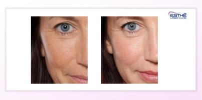 Služba – kožní výplně 2337