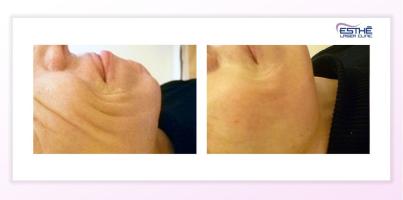 Výplně – koutky úst a vrásky na tvářích