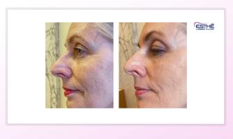Služba – kožní výplně 2334