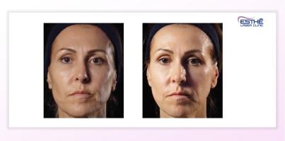 Služba – Profhilo Structura 2320