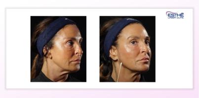 Služba – Profhilo Structura 2323