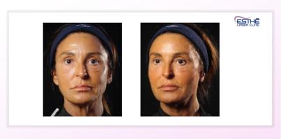 Služba – Profhilo Structura 2322